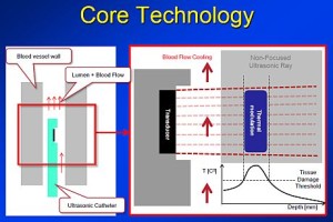 קרדיוסוניק קטטר