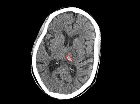 תמונת מוח שפוענחה בפלטפורמת הענן של MedyMatch